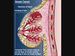 Malignant breast masses usually occur in older men and often only on one side. Symptoms Of Breast Cancer In Hindi Canceroz Atatun