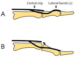 Image result for Elson Extensor Tendon Test