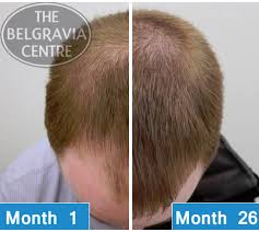 I was recommended by a relative to the belgravia centre due to sudden hair loss. Bald For 20 Years But This Man Still Misses His Hair