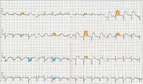 Initial ecg findings are not reliable in detecting patients with an indication for ica after experiencing a cardiac arrest. Figure 12 Lead Ecg Ekg Showing Statpearls Ncbi Bookshelf