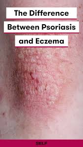 The symptoms of eczema generally include inflammation, dryness, and eczema is not contagious, which means that a person cannot catch it or pass it onto another person. Psoriasis And Eczema Are Both Forms Of Dermatitis But Come With Very Different Symptoms And Causes Here Is What Yo Skin Conditions Psoriasis Psoriasis Eczema