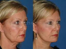 Naturally, the internet had some thoughts about the look, and folks were wondering what happened to the blinding lights hitmaker. Facelift Santa Barbara Short Scar Mini Facelift Dr Sheffield