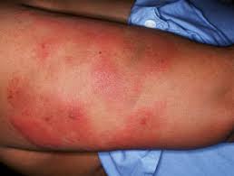 La trombocitopenia es cuando hay una cantidad menor de la normal de plaquetas en el torrente sanguíneo. Trombocitopenia Inducida Por Heparina Dermatly Com El Sitio De Tu Piel