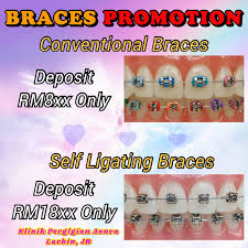 Jom kita tengok proses pemasangan braces doktor juga ada beritahu kenapa kes patient ni perlu memakai braces. Klinik Pergigian Azura Larkin Jb Posts Facebook