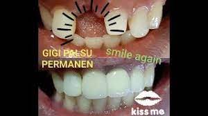 We did not find results for: Pasang Gigi Palsu Permanen Di Depan Ibu Ini Bisa Tersenyum Kembali Youtube
