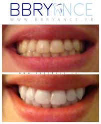 La poudre de charbon pour les dents est en effet composée de microparticules à la surface poreuse qui viennent frotter l'émail et absorbent les substances c'est plutôt sous la forme de poudre libre que le charbon actif est utilisé pour blanchir les dents. Traiter Des Dents Jaunes Pour Obtenir Des Dents Blanches Kit Blanchiment Dentaire Bbryance C