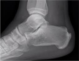 Calcific Achilles Tendonitis In Athletes Podiatry Today