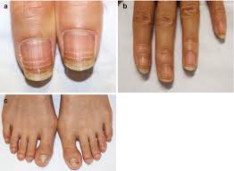 Image result for Beau lines feet