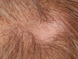 When it affects scalp, lichen planus causes inflammation or irritation on scalp, which ends up affecting hair health and may even cause irreversible hair loss. Lichen Planopilaris Dermnet Nz