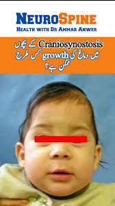 Craniosynostosis Signs