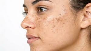 Image result for Photodermatitis
