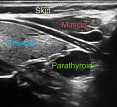 However, the mammogram is the primary screening tool for women who. Parathyroid Scans For Abnormal Parathyroid Glands Dr Babak Larian