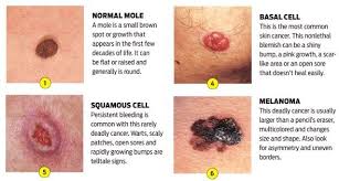 Melanoma skin cancer is a serious type of cancer if not treated at an early stage. Pin On Tim Hiá»ƒu Ung ThÆ°