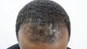 The condition affects both white and black men. What Black Men Should Do About Thinning Hair Mrcottontop
