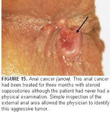 Skin cancer is the most common type of cancer in the united states by a pretty large margin, and it does not discriminate. Anal Cancer That You Wanted To Know But To Shy To Ask N45 Dr Halimah Ali