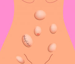 Hernias Da Parede Abdominal Denominacoes Especificas Blog Jaleko