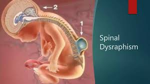 Image result for Spinal Dysraphism
