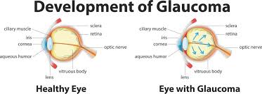 Cataract surgery is the main treatment. Glaucoma Vs Cataracts Whats The Difference Vision Center