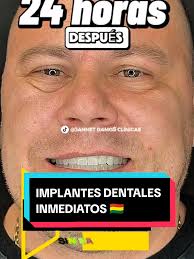 🇧🇴 IMPLANTES DENTALES INMEDIATOS. Un implante dental inmediato no es  únicamente una solución médica, es un puente entre lo que fuiste y lo que  deseas volver a ser. Es recuperar la libertad de sonreír ...
