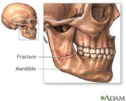 Image result for Jaw Dislocation