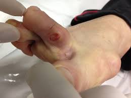 Como remover cravos no nariz em casa. Clinica E Cirurgia Do Pe E Tornozelo