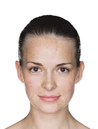 Fine hair, meet your match! What To Expect With Differin Acne Treatment Differin Gel