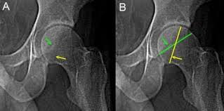 Image result for Femoral Retroversion