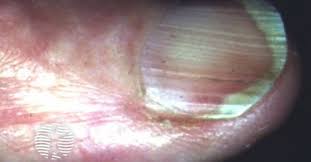 Image result for Koilonychia feet