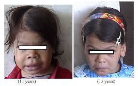 What is pediatric graves' disease? Congenital Hypothyroidism Effects On Linear Growth Catch Up Growth Gh Igf I Axis And Bones Intechopen