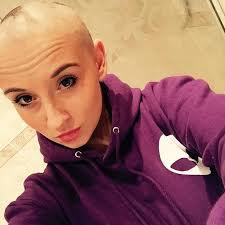 Teenager Is Left Bald After Her Long Locks Fell Out Has Alopecia Grey Hair Pieces Balding Hair Falling Out