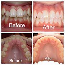 Great Results With A Palatal Expander And Braces At Amanda Gallagher Orthodontics Agortho Live Lokai Bracelet Orthodontics Lokai Bracelet
