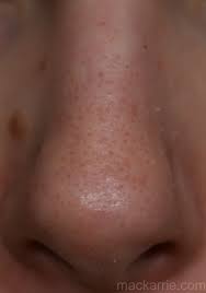 Anders als pickelnarben, die eine unebene hautoberfläche zeigen, sind pickelmale lediglich verfärbte hautstellen. Mackarrie Beauty Style Blog Clarisonic Mia 2 Review