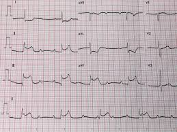 El ecg es básico en el diagnóstico del infarto agudo de miocardio. Ecg Now