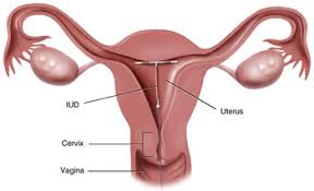 In the (again, rare) case of expulsion,. Iud Insertion Everywoman S Health Centre