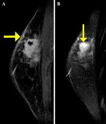 To help determine the extent of breast cancer: Mri Findings Of Inflammatory Breast Cancer Locally Advanced Breast Cancer And Acute Mastitis T2 Weighted Images Can Increase The Specificity Of Inflammatory Breast Cancer Springerlink