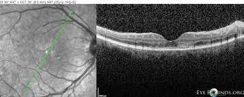 Apmppe affects otherwise young healthy adults and presents as a disorder affecting the retina, retinal pigment epithelium and choroid. Acute Posterior Multifocal Placoid Pigment Epitheliopathy Apmppe