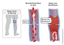 Leg muscle diagram muscles of the hips and thighs human anatomy and physiology lab. Deep Vein Thrombosis