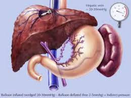 Aetna considers transjugular intrahepatic portosystemic shunt (tipss) transjugular intrahepatic portosystemic shunt was very effective in decreasing the portosystemic pressure gradient from. Tipss Transjugular Intrahepatic Porto Systemic Shunt Youtube