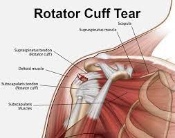 Shoulder tendon anatomy diagram / causes and treatment for rotator cuff tears : Rotator Cuff Tear Gold Coast Hand Upper Limb Clinic