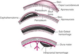Image result for Vacuum Caput