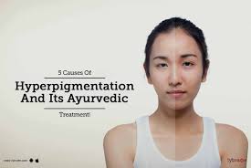 Hyperpigmentation is usually a cosmetic concern rather than a medical one. 5 Causes Of Hyperpigmentation And Its Ayurvedic Treatment By Dr Surjeet Kaur Bava Lybrate