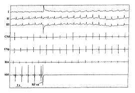 Primary pacemaker is within the av junction but rate is faster than the intrinsic rate of 60 and less than 100. An Accelerated Junctional Rhythm Occurring 5 S After The Onset Arrow Download Scientific Diagram