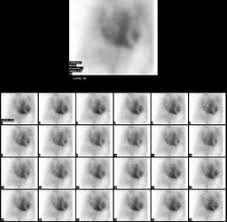 Image result for Nuclear Ventriculogram