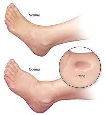 Maybe you would like to learn more about one of these? Edema Ubat Sakit Buah Pinggang