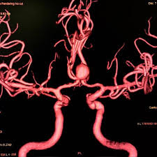 The most reliable test is called a diagnostic cerebral angiogram. Aneurisma Cerebral Neurochirurgie