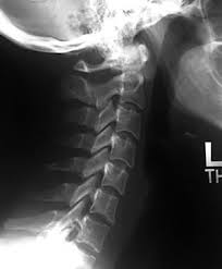 This procedure may be used to diagnose back or neck pain, fractures or broken bones, arthritis, degeneration of the disks, tumors, or other problems. X Rays Spine