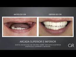 Antes E Depois Implante Dentario Protocolo Youtube Youtube It Works Advertising