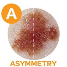Thank you, {{form.email}}, for signing up. Melanoma Detection The Abcde Rule Reid Health