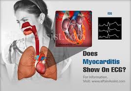 With inflammation of the adjacent pericardium, ecg features of pericarditis can also been. Does Myocarditis Show On Ecg