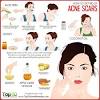Here's your guide on how to get rid of acne scars naturally, safely and quickly. 1